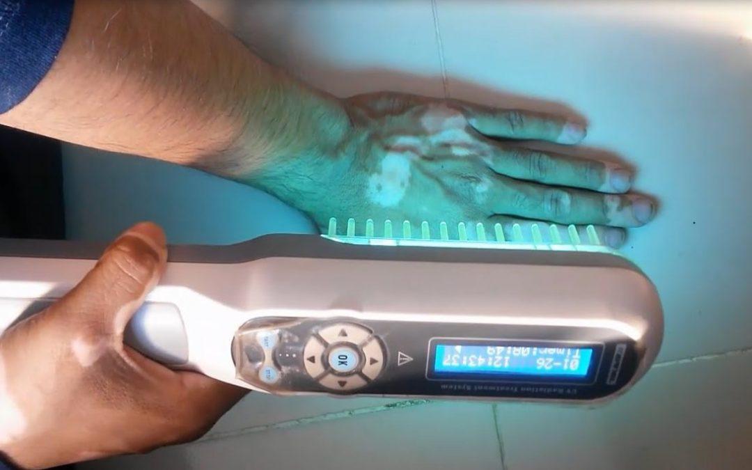 Narrowband UVB Light Treatment at Apollo Dermatology