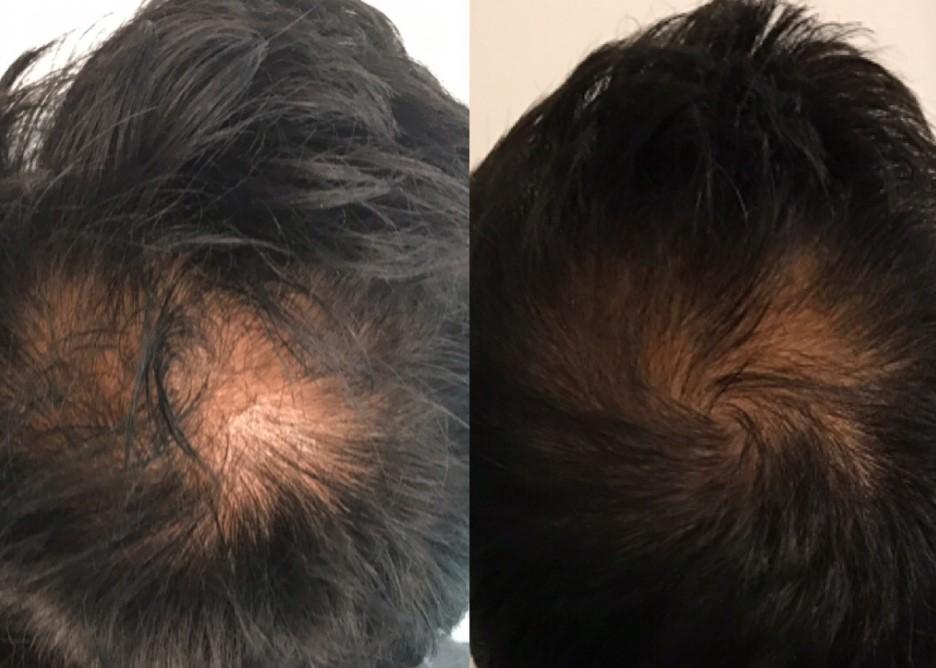 Platelet Rich Plasma (PRP): The Most Natural Way to Treat Hair Loss - Dr.  Arjun Dupati Rochester Hills Dermatologists