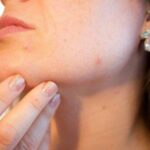 Acne Treatments Accutane Troy MI