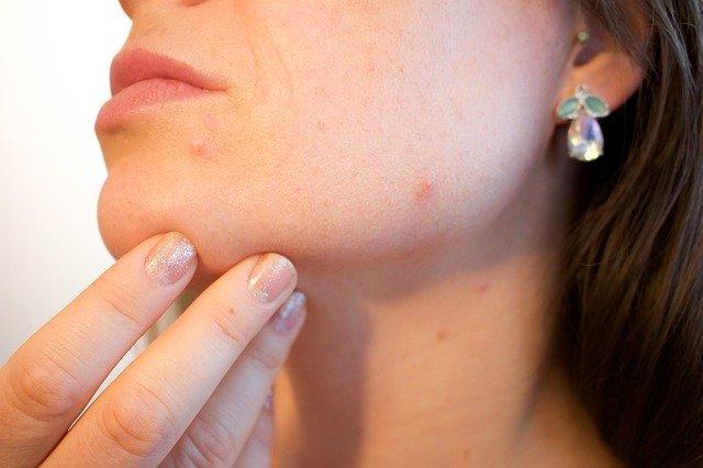 How Does a Board Certified Dermatologist Diagnose Acne?