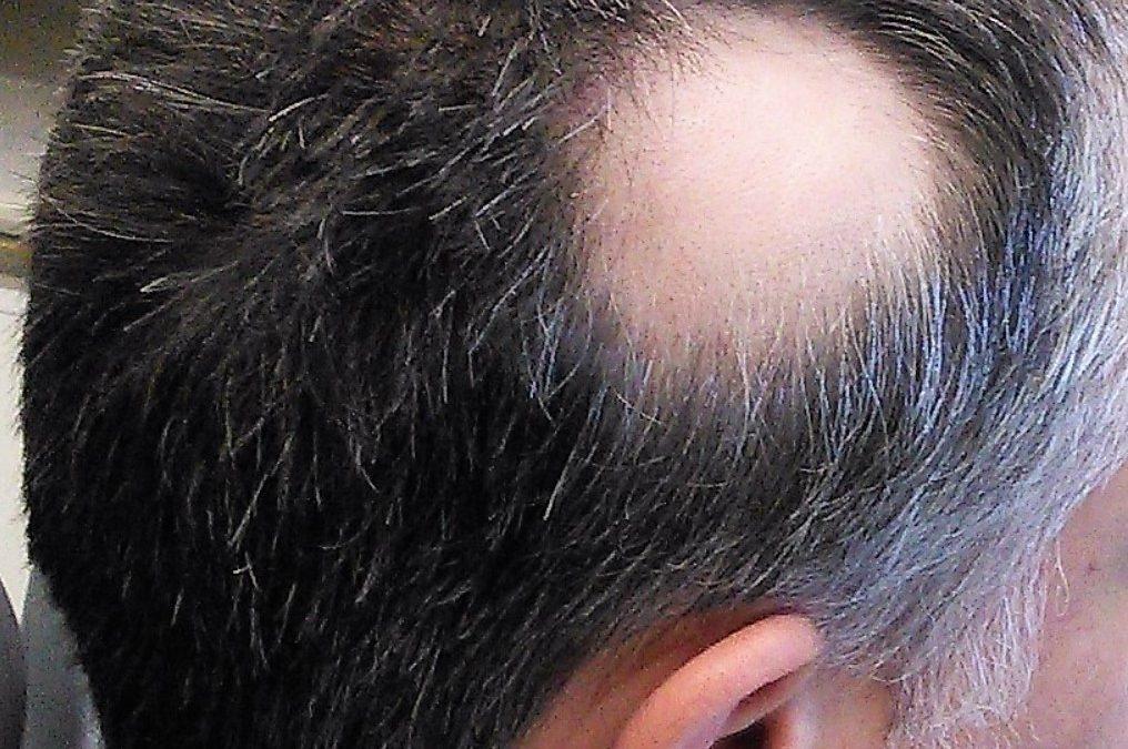 Alopecia – Hair Loss