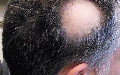 Alopecia – Hair Loss