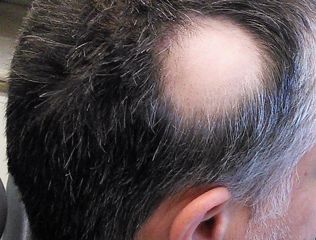 Alopecia Hair Loss Apollo Dermatology