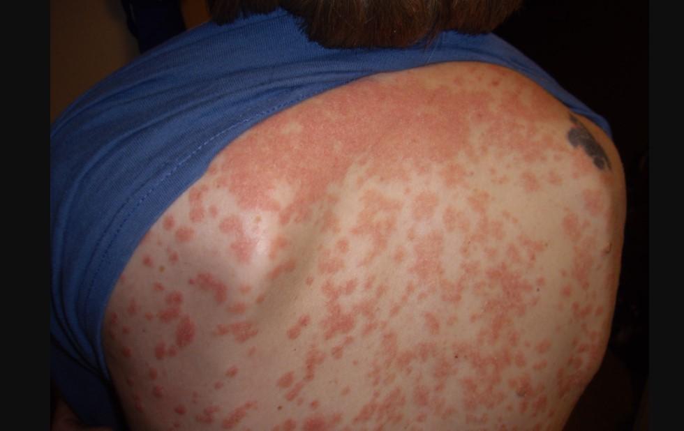 Can Psoriasis Be Treated?
