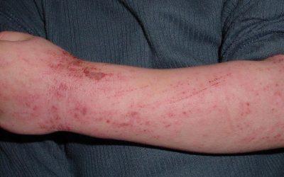 The Many Forms of Eczema (Dermatitis)