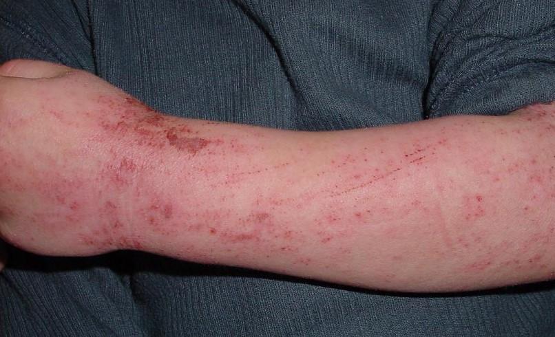 Eczema Dermatitis