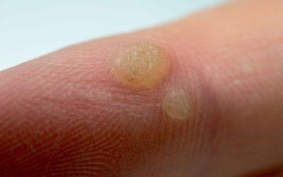Warts are Stubborn and Wart Treatments Take A Long Time