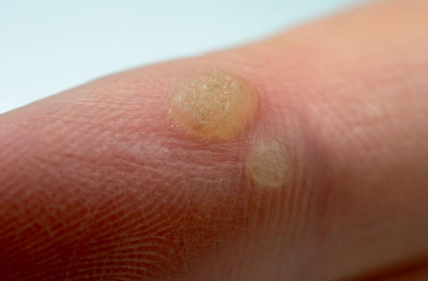 Warts are Stubborn and Wart Treatments Take A Long Time