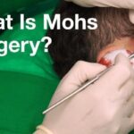 Mohs Surgery Apollo Dermatology Michigan