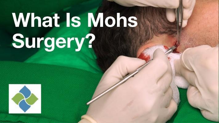 Mohs Surgery: Treatment of Skin Cancer