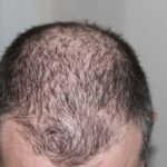PRP for hair loss Apollo Dermatology Michigan