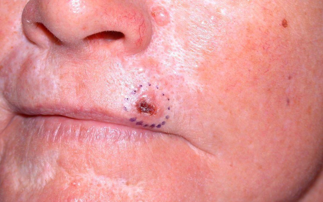 Basal Cell Carcinoma treatment at Apollo Dermatology Troy Michigan