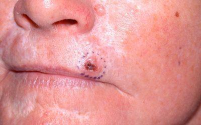 Basal Cell Carcinoma (Basal Cell Skin Cancer)