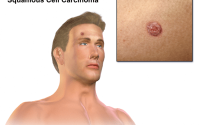Squamous Cell Carcinoma (Squamous Cell Skin Cancer)