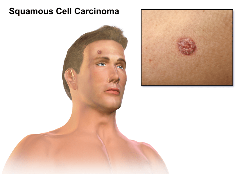 Squamous Cell Carcinoma (Squamous Cell Skin Cancer)