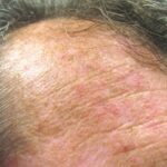 Actinic Keratosis Treatment at Apollo Dermatology Troy MI