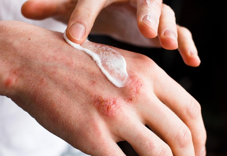 Topical Steroids: A Prescribed Medication for the Treatment of a Variety of Skin Problems