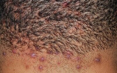 Acne Keloidalis Nuchae (AKN): Causes, Treatments, and Why Early Intervention Matters