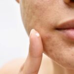 Understanding Acne - Why Personalized Care is Essential for Clearer Skin Dermatologist in Troy MI Rochester Hills MI