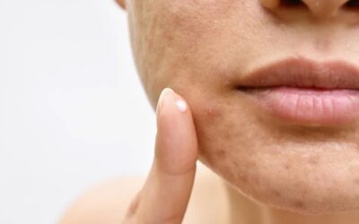 Acne: Why Personalized Care is Essential for Clearer Skin