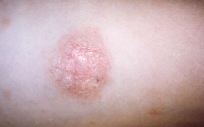 Pityriasis Rosea: What Is It and How Can It Be Treated?