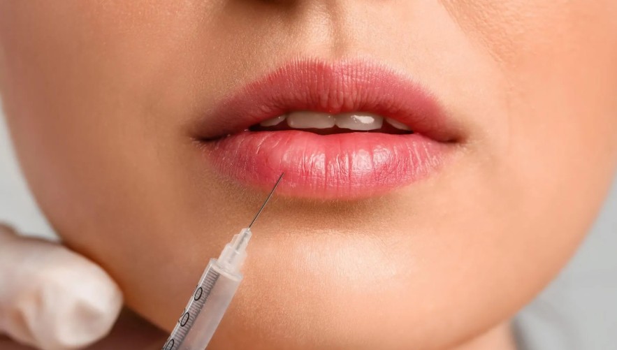 Lip Filler Treatments at Apollo Dermatology Troy Rochester Hills MI
