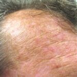 Why Treating Actinic Keratoses Matters - Preventing Skin Cancer Early Apollo Dermatology Troy MI