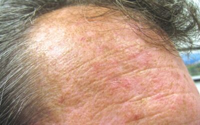 Actinic Keratosis: Why Pre-Cancerous Skin Lesions Shouldn’t Be Ignored
