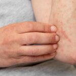 Shingles Treatment in Rochester Hills Early Diagnosis Matters – Apollo Dermatology