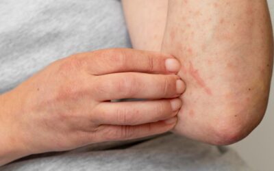 Shingles Treatment in Rochester Hills  Early Diagnosis Matters – Apollo Dermatology