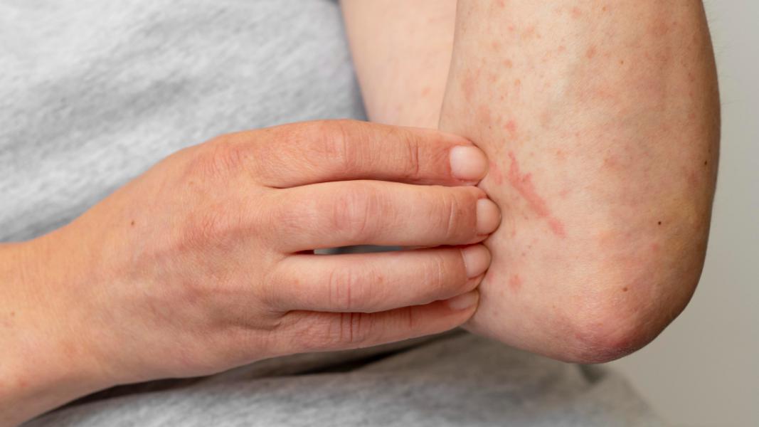 Shingles Treatment in Rochester Hills Early Diagnosis Matters – Apollo Dermatology