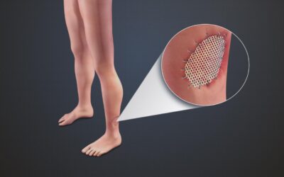 Understanding Kerecis Fish Skin Grafts: A Helpful Tool for Healing After Mohs Surgery