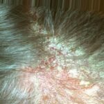 Understanding Seborrheic Dermatitis Apollo Dermatology Rochester Hills