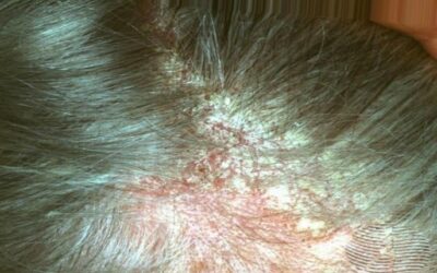 Understanding Seborrheic Dermatitis