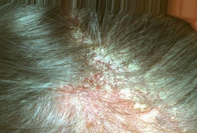 Understanding Seborrheic Dermatitis Apollo Dermatology Rochester Hills